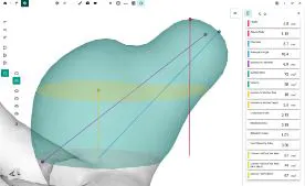 Blood Flow CFD by FlowLens