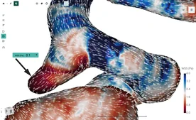 Blood Flow CFD by FlowLens