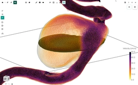 Blood Flow CFD by FlowLens