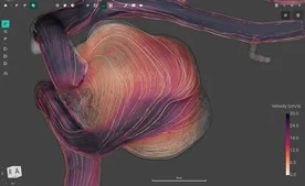 Blood Flow CFD by FlowLens